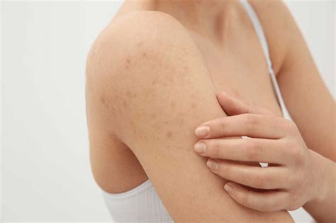 Tavuk Derisi Cilt Nasıl Geçer Keratosis Pilaris Nedir Ve Nasıl Tedavi Edilir