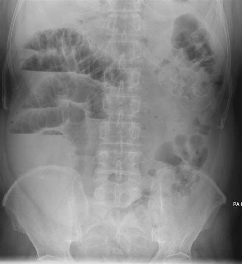 Ct Case 048 • Litfl • Ct Scan Interpretation