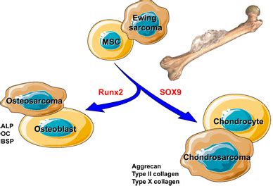 Origin Of Bone Sarcomas Based On The Current Knowledge Osteosarcoma