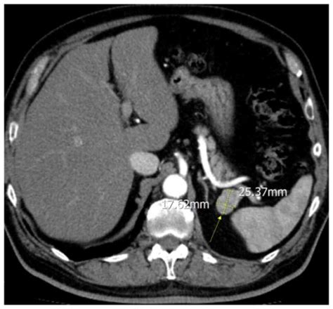 Imaging‑based Diagnosis Of Intrapancreatic Accessory Spleen A Case Report