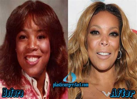 Wendy Williams Plastic Surgery Before and After