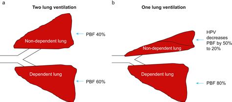 Hypoxaemia During One Lung Ventilation Bja Education