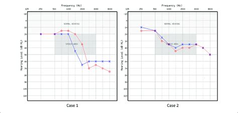 Air Conduction Audiometric Thresholds In Db Hl For The Two Cases Red Download Scientific