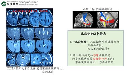 【会议报道】四川大学华西医院胶质瘤多学科诊疗（mdt）院际交流恶性肿瘤手术中国抗癌协会