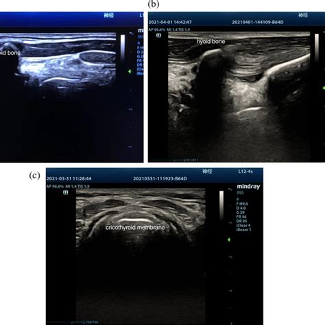 Ultrasound Guided Sln Block And Transtracheal Injection Note A The