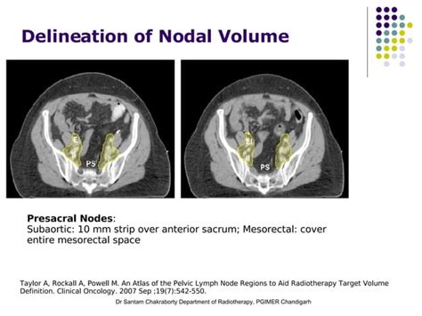 Imrt And 3d Crt In Cervical Cancers Ppt