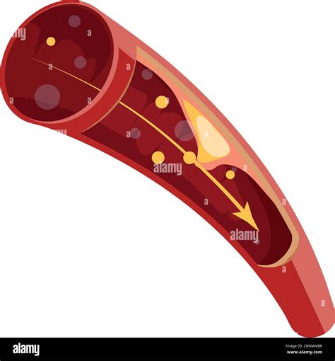 Blood Trombosis Formation Atherosclerosis Artery Medical Illustration