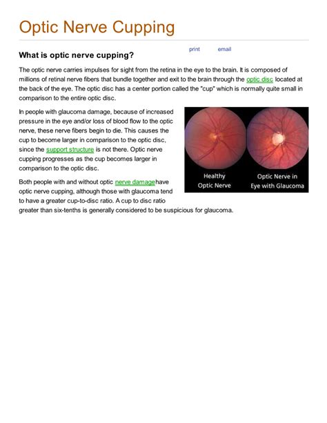 Medical Facts: Optic nerve cupping