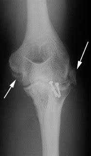 Anteroposterior Ap Radiograph Of The Left Elbow Case Seven