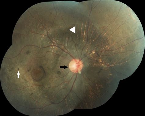 Retinitis Pigmentosa British Journal Of Medical Practitioners