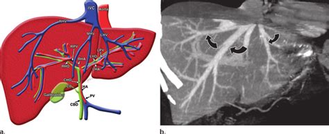 Hepatic Venous Anatomy A Illustration Shows The Venous And Arterial