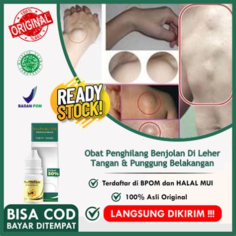 Obat Penghilang Benjolan Di Leher Kelenjar Getah Bening Di Leher Obat