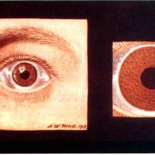 (PDF) Images of Lisch nodules across the spectrum