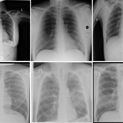 Example Chest X Ray Images From The Dataset Introduced By Rahman Et Al Download Scientific