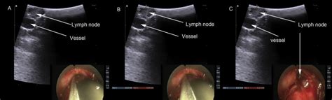 Ultrasound-Guided Video-Assisted Mediastinoscopic Biopsy: A Novel ...