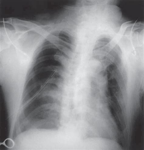 Chest X Ray Fi Lm Showing The Collapsed Lung Download Scientific Diagram