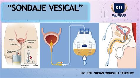 SONDA VESICAL 1 Susan Conislla Tercero UDocz