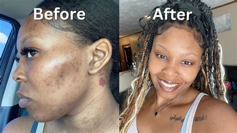 How I Cleared My Acne Dark Spots Hyperpigmentation In 1 Month