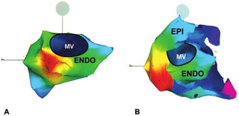 Carto Activation Maps Of Vt From Patient Described In Legend To Figure