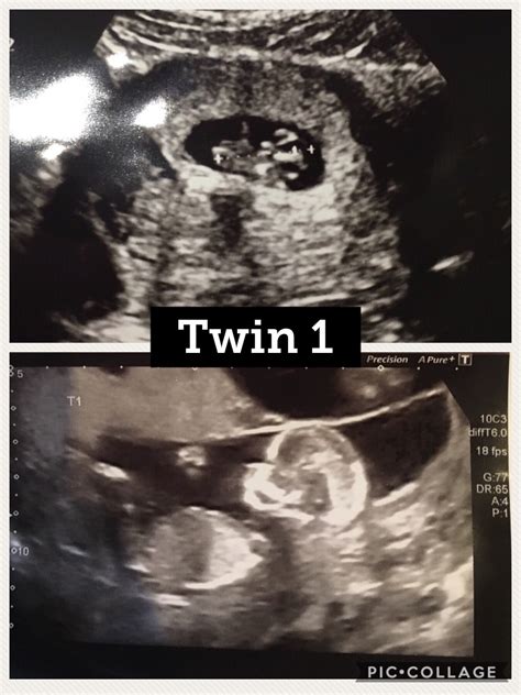 13 Week Twins Scan Gender Guesses