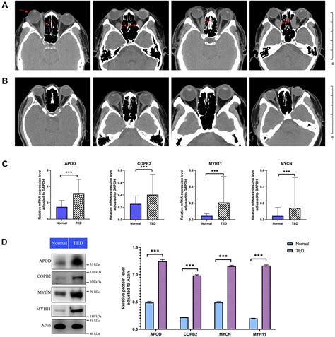 Novel Insights Into The Pathogenesis Of Thyroid Eye Disease Through