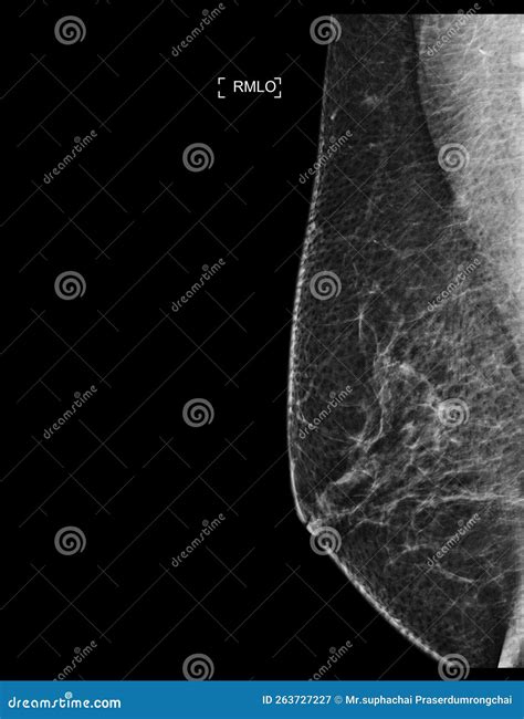 X-ray Digital Mammogram Or Mammography Of Both Side Breast Showing Benign Tumor BI-RADS 2 Should ...