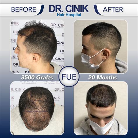 1 Year Fue Hair Transplant Results From Istanbul Turkey Before And