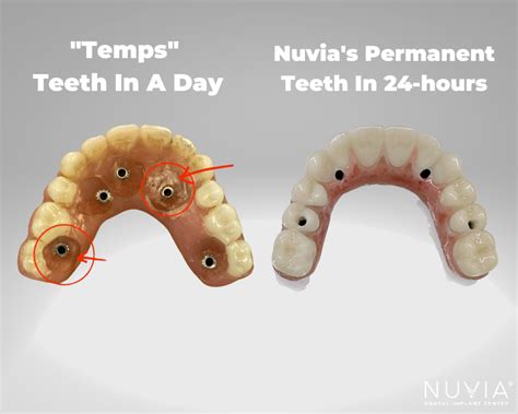 Teeth In A Day Vs NUVIAs Permanent Teeth In 24 Hours