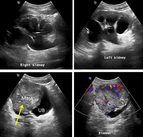 Squamous Cell Carcinoma Of Urinary Bladder Radiology Cases