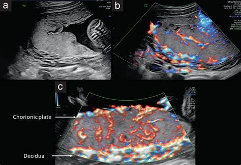 Chorionic Plate