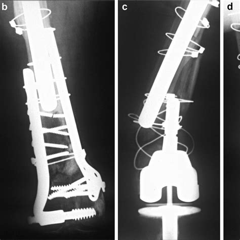 Ap Radiograph Of Right Hip A And Knee B After Initial Hip Revision