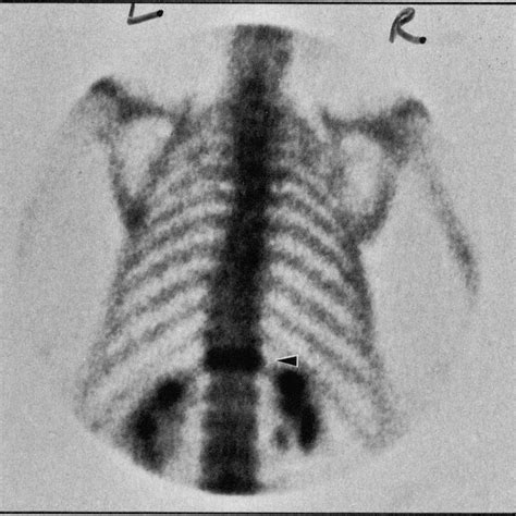 Lb A Dual Phase Technetium 99m Methylene Diphosphonate Bone Scan In Download Scientific