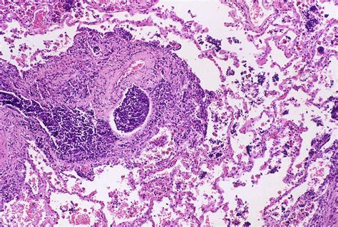 Oat Cell Carcinoma In Human Lung, Lm Photograph by Michael Abbey | Pixels