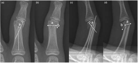 Corrective Osteotomy For Distal Condylar Malunion Of The Proximal