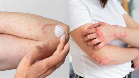 Fungal Infections Of The Skin Symptoms Causes And Off