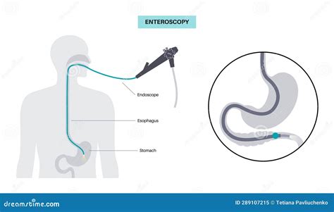 Esophagogastroduodenoscopy Medical Procedure Stock Vector