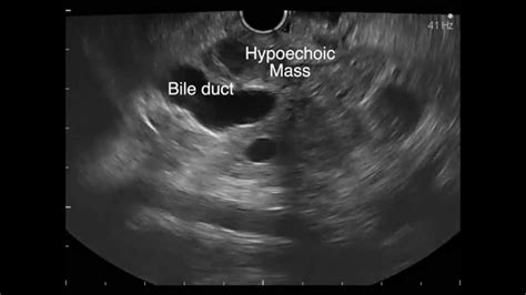 Endoscopic Ultrasound Fna Of A Pancreatic Mass Youtube