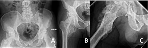 Early Resection Of Ectopic Bone In Patients With Heterotopic Ossification About The Hip After