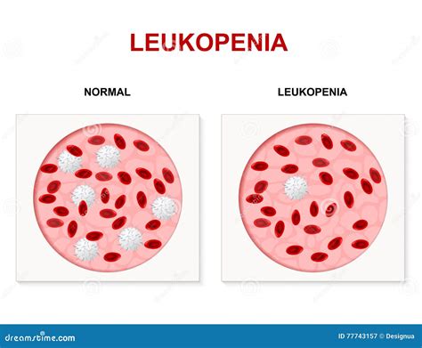 Leukopenia, Leukocytopenia Or Leucopenia Cartoon Vector | CartoonDealer ...