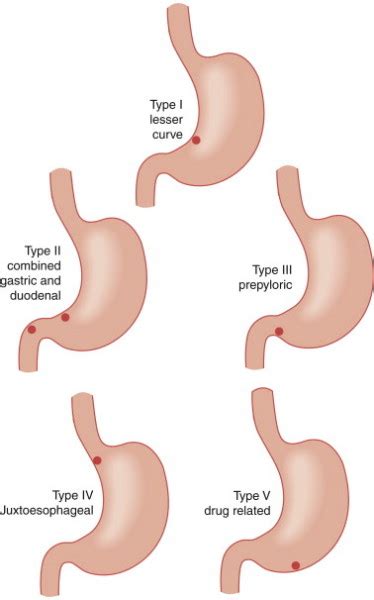 Gastric Ulcer Types