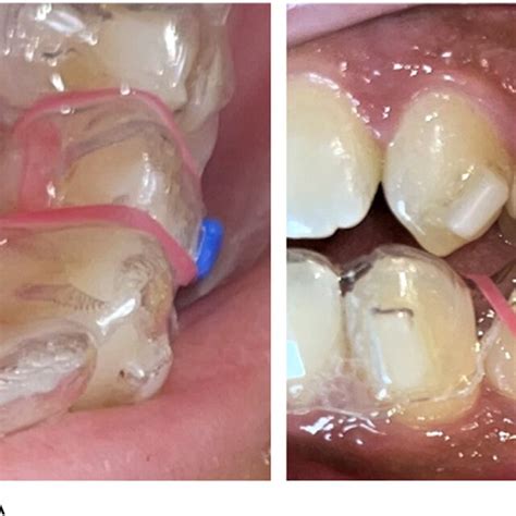 A C Illustrate Mini Pin Supported Single Tooth Mesialization For The