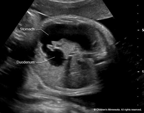 Duodenal Atresia Fetal Ultrasound