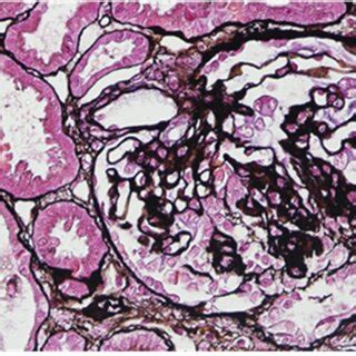 Representative Pathological Images Of Renal Biopsy Specimen Form Case