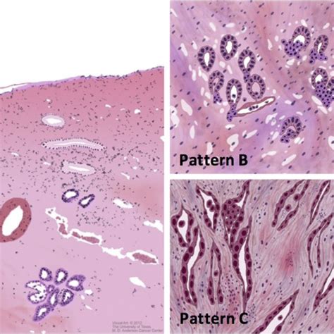 Various Histological Types Of Adenocarcinoma A Endocervical