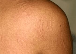 Dermographism- Symptoms, Causes & Herbal Treatment - Dr. Vikram's Blog ...
