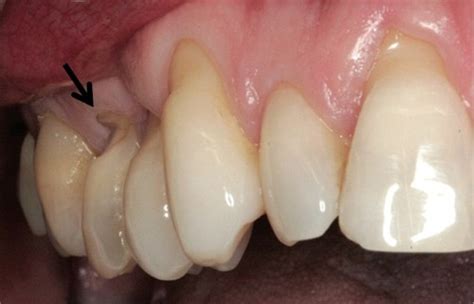 Full Article Abfraction Lesions Etiology Diagnosis And Treatment