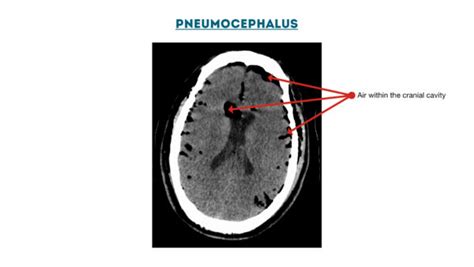 CT Head Interpretation | Radiology | Geeky Medics