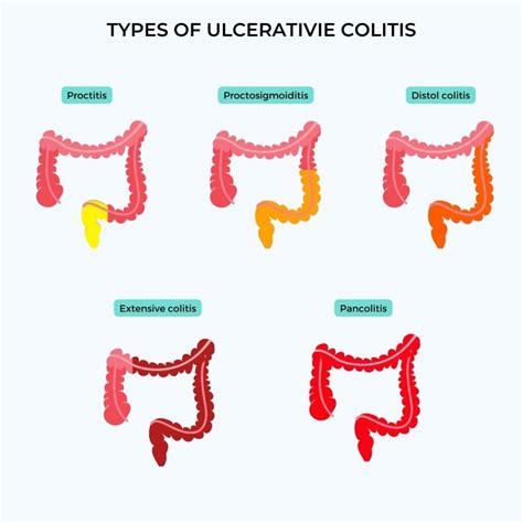 Is Ulcerative Colitis Genetic