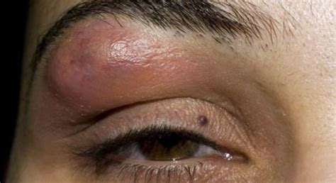 Lump In Eyebrow Bone Causes Above Eyebrow Cancer Headache Hard