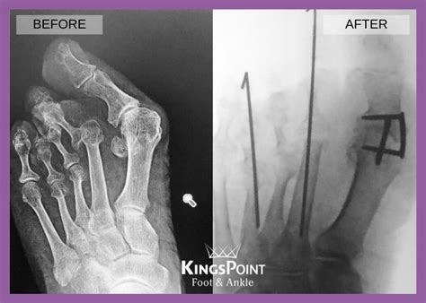 First Metatarsal-phalangeal Joint (MTP) Arthrodesis | Foot and Ankle ...